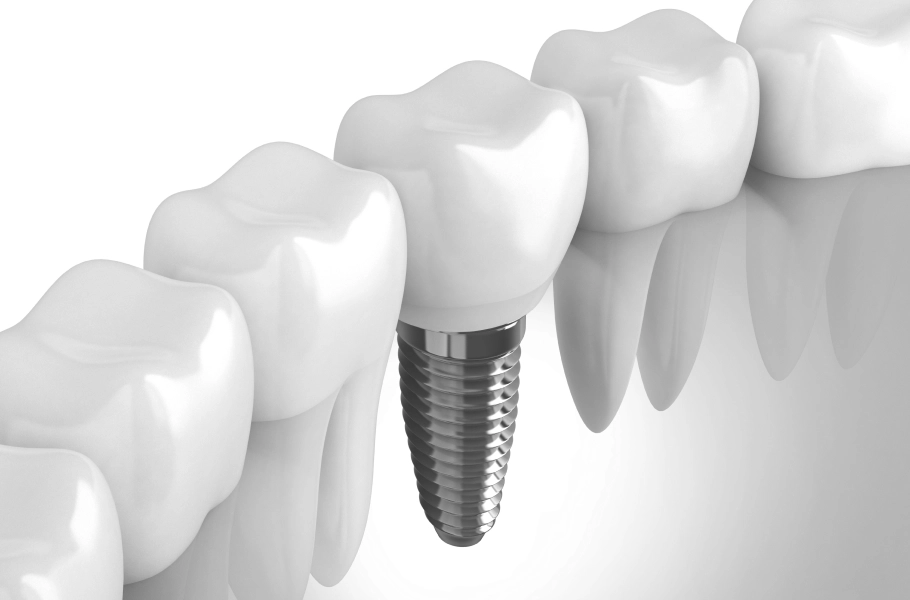 Dental Implant Dentistry
