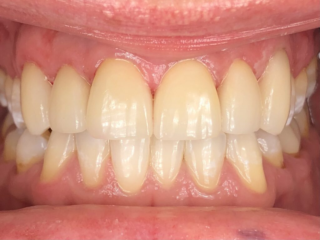 After case 1