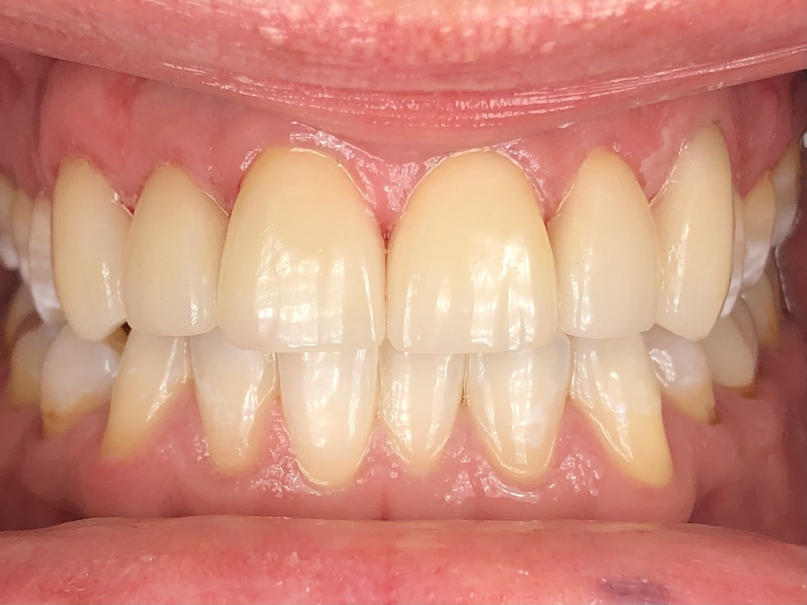 After case 1