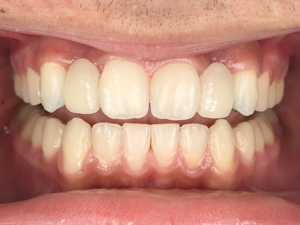 After case 4