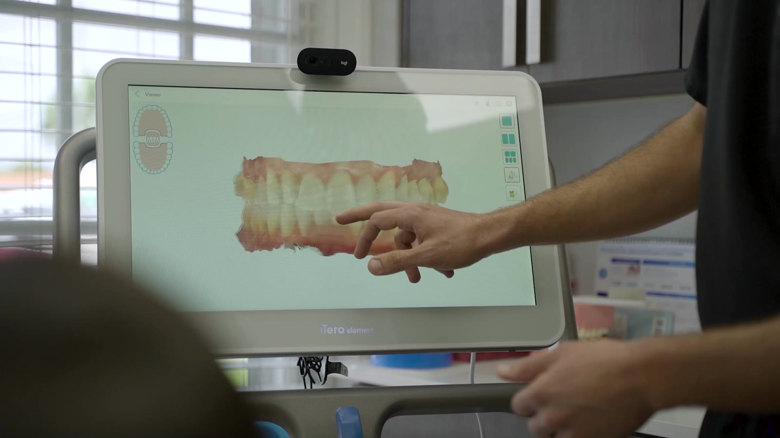 Digital scan of teeth shown on a monitor