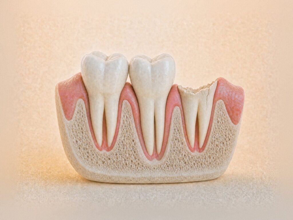 Illustration of a broken back tooth