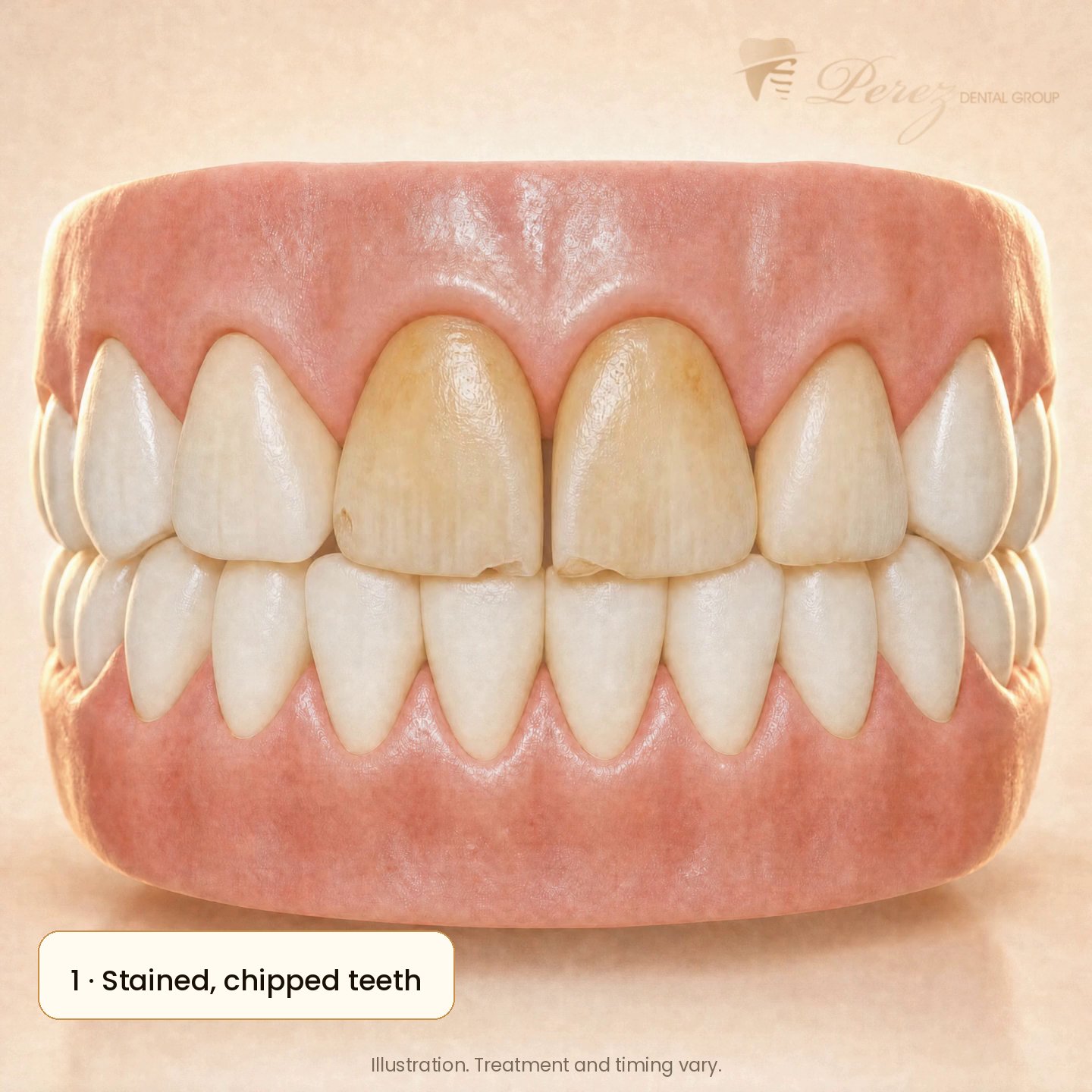 Illustration of front teeth with porcelain veneers bonded in place