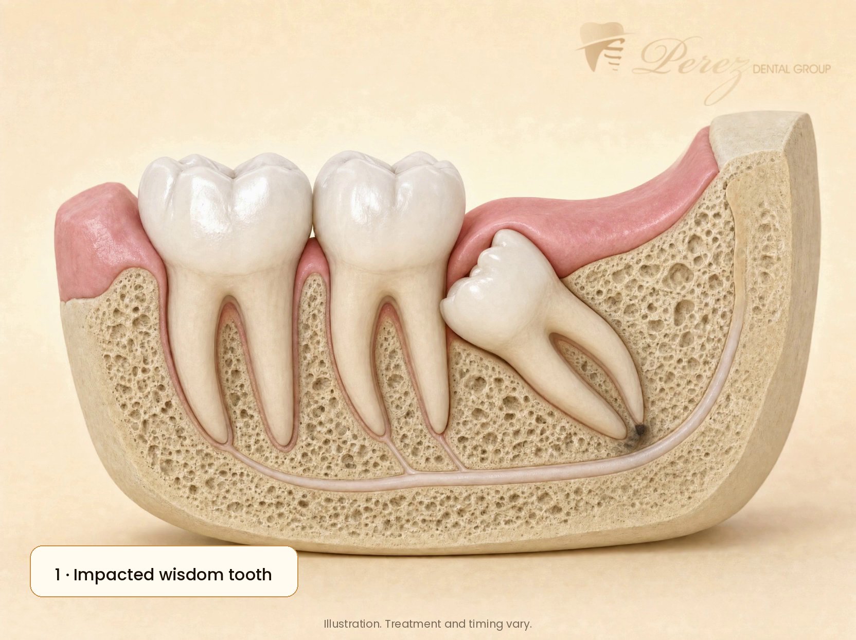 Illustration of a healed jaw after wisdom tooth removal